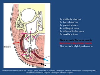 Palatal Infection Comprehensive Overview of Complex Odontogenic Infections and Deep ...