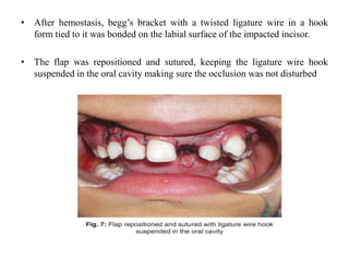 • After hemostasis, begg’s bracket with a twisted ligature wire in a hook
form tied to it was bonded on the labial surface of the impacted incisor.
• The flap was repositioned and sutured, keeping the ligature wire hook
suspended in the oral cavity making sure the occlusion was not disturbed
 