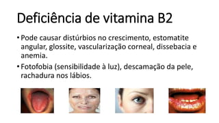 Deficiência de vitamina B2
• Pode causar distúrbios no crescimento, estomatite
angular, glossite, vascularização corneal, dissebacia e
anemia.
• Fotofobia (sensibilidade à luz), descamação da pele,
rachadura nos lábios.
 