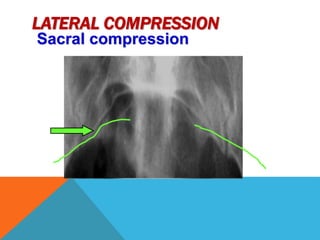 Complex pelvic trauma 1 | PPTX
