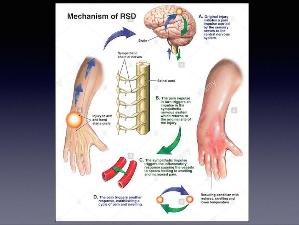 Complex Regional Pain Syndrome