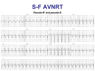 S-F AVNRT
Pseudo-R’ and pseudo-S
 