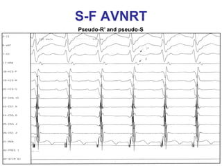 S-F AVNRT
Pseudo-R’ and pseudo-S
 