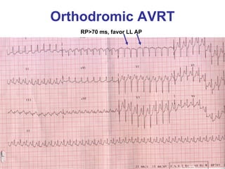 Orthodromic AVRT
   RP>70 ms, favor LL AP
 
