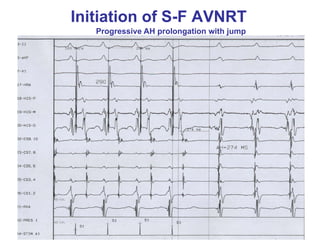 Initiation of S-F AVNRT
   Progressive AH prolongation with jump
 