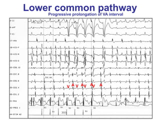 Lower common of VA interval
    Progressive prolongation
                             pathway




             V A V AV AV   A
 