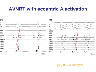 AVNRT with eccentric A activation




                    (Ong M. et al. IJC 2007)
 