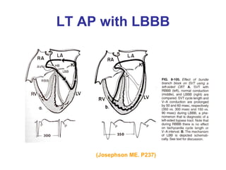 LT AP with LBBB




     (Josephson ME. P237)
 