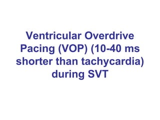 Ventricular Overdrive
 Pacing (VOP) (10-40 ms
shorter than tachycardia)
       during SVT
 