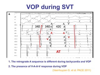VOP during SVT



                                   A           A
                                                   V
                               V




                                          AT

1. The retrograde A sequence is different during tachycardia and VOP
2. The presence of V-A-A-V response during VOP
                                       (Veenhuyzen G. et al. PACE 2011)
 
