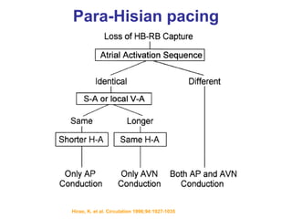 Para-Hisian pacing




Hirao, K. et al. Circulation 1996;94:1027-1035
 