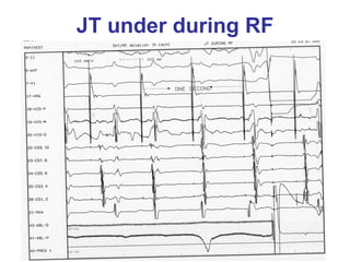 JT under during RF
 