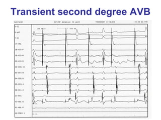Transient second degree AVB
 