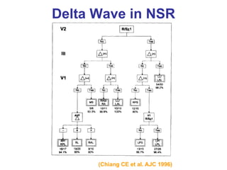Delta Wave in NSR




      (Chiang CE et al. AJC 1996)
 