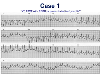 Case 1
VT, PSVT with RBBB or preexcitated tachycardia?
 