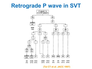 Retrograde P wave in SVT




           (Tai CT et al. JACC 1997)
 
