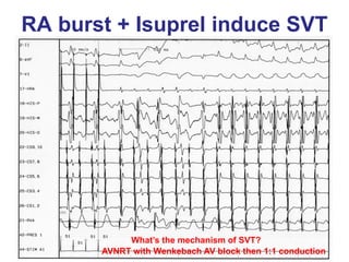 RA burst + Isuprel induce SVT




            What’s the mechanism of SVT?
       AVNRT with Wenkebach AV block then 1:1 conduction
 