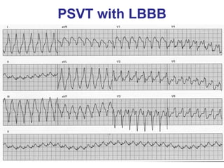 PSVT with LBBB
 