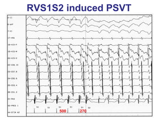 RVS1S2 induced PSVT




     500   270
 