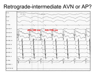 Retrograde-intermediate AVN or AP?



         AH=188 ms   HA=158 ms
 