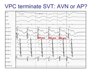 VPC terminate SVT: AVN or AP?




           347 ms   347 ms 293 ms
 