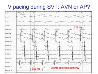 V pacing during SVT: AVN or AP?


                                  372 ms




         350 ms   Lower common pathway
 