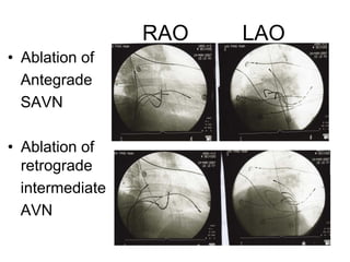 RAO   LAO
• Ablation of
  Antegrade
  SAVN

• Ablation of
  retrograde
  intermediate
  AVN
 