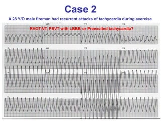 Case 2
A 28 Y/O male fireman had recurrent attacks of tachycardia during exercise

           RVOT-VT, PSVT with LBBB or Preexcited tachycardia?
 