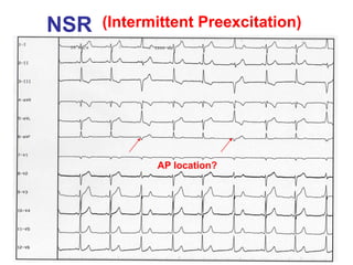 NSR   (Intermittent Preexcitation)




             AP location?
 