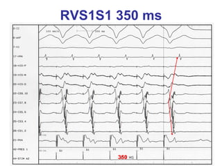 RVS1S1 350 ms




       350
 