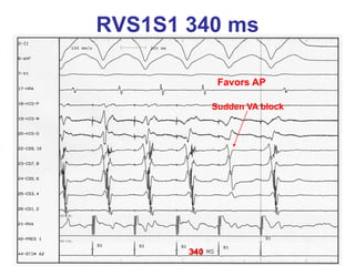 RVS1S1 340 ms

              Favors AP

             Sudden VA block




       340
 