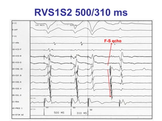 RVS1S2 500/310 ms

            F-S echo
 