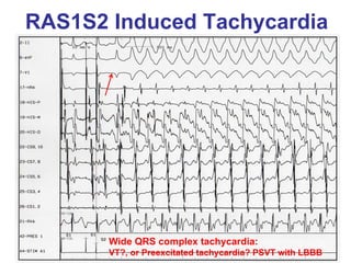 RAS1S2 Induced Tachycardia




       Wide QRS complex tachycardia:
       VT?, or Preexcitated tachycardia? PSVT with LBBB
 