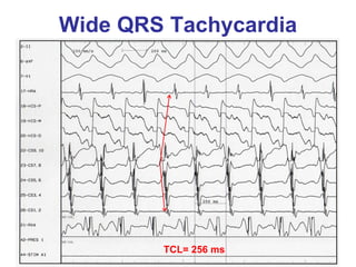 Wide QRS Tachycardia




        TCL= 256 ms
 