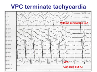 VPC terminate tachycardia

                Without conduction to A




                  VPC
                  Can rule out AT
 
