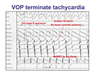 VOP terminate tachycardia

                           Sudden VA block
   The same A sequence
                         No lower common pathway




                          AVNRT is not likely
 