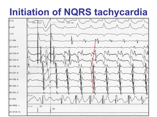 Initiation of NQRS tachycardia
 