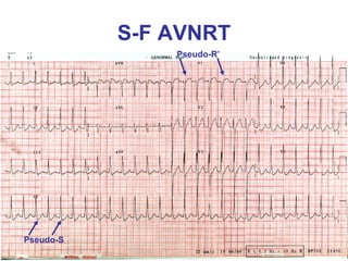 S-F AVNRT
               Pseudo-R’




Pseudo-S
 