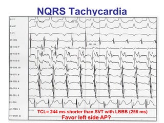 NQRS Tachycardia




TCL= 244 ms shorter than SVT with LBBB (256 ms)
          Favor left side AP?
 