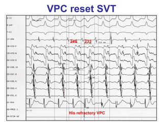 VPC reset SVT


    248    233




    His refractory VPC
 