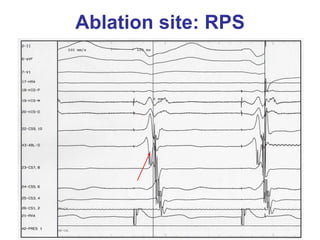 Ablation site: RPS
 
