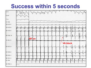 Success within 5 seconds




      RF on

                 VA block
 