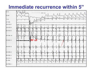 Immediate recurrence within 5”




        RF off
 