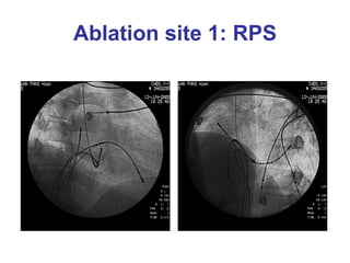 Ablation site 1: RPS
 
