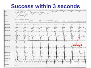 Success within 3 seconds




                     VA block
 