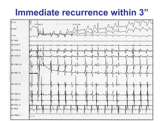 Immediate recurrence within 3”
 