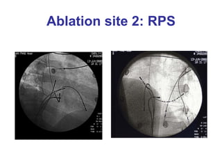 Ablation site 2: RPS
 