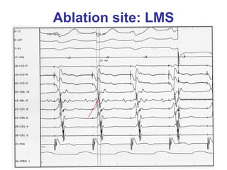 Ablation site: LMS
 