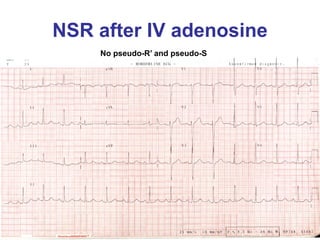 NSR after IV adenosine
    No pseudo-R’ and pseudo-S
 