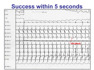 Success within 5 seconds




                    VA block
 